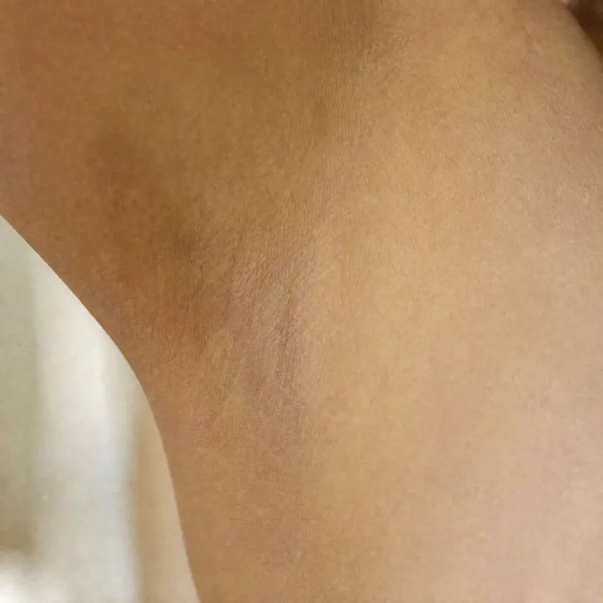 The same underarm, clear, two weeks later