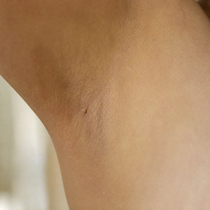 A skin tag in the underarm fold before treatment